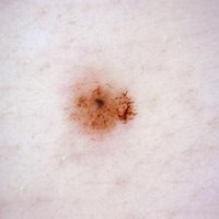 Skin Cancer Classification project thumbnail