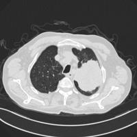 lungcancer project thumbnail