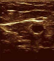 Ultrasound segmentation Yolo8 project thumbnail