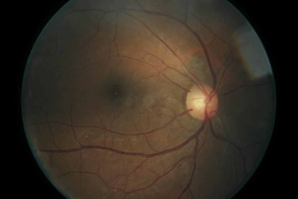 Diabetes eye classification dataset and pre trained model by diabetes