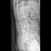 Spinopelvic Landmark Detection project thumbnail