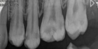 Dental Caries X-ray project thumbnail