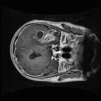 Brain Cancer Segmentation project thumbnail