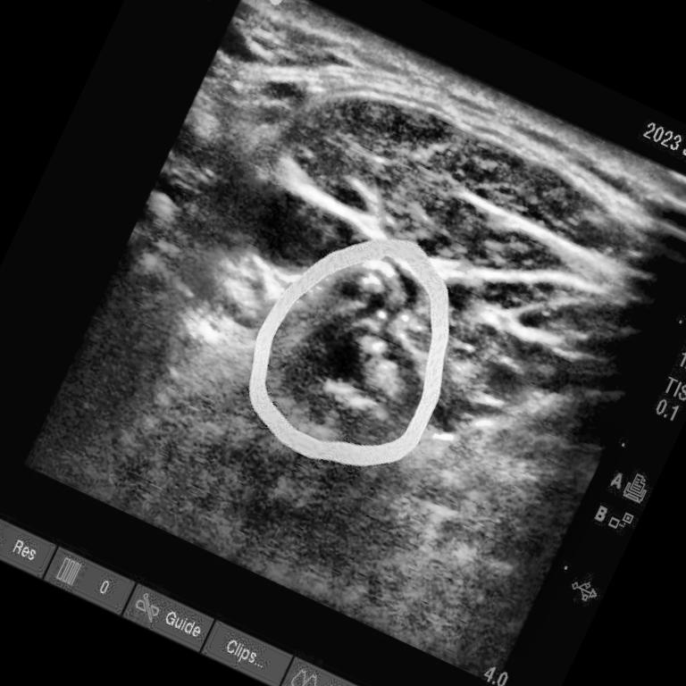 stenose-new-instance-segmentation-dataset-by-heh