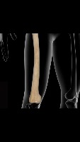 Bone-fracture project thumbnail