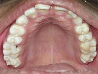 maxillary project thumbnail