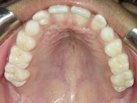 maxillary 1 project thumbnail