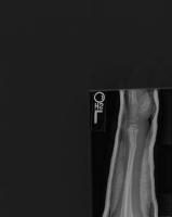 bone dect project thumbnail
