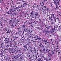 Signet Ring Cell Detection project thumbnail