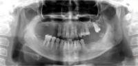 Condlye Segmentation project thumbnail