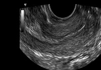 PCOS Detection Object Detection Dataset by PCOS Dataset