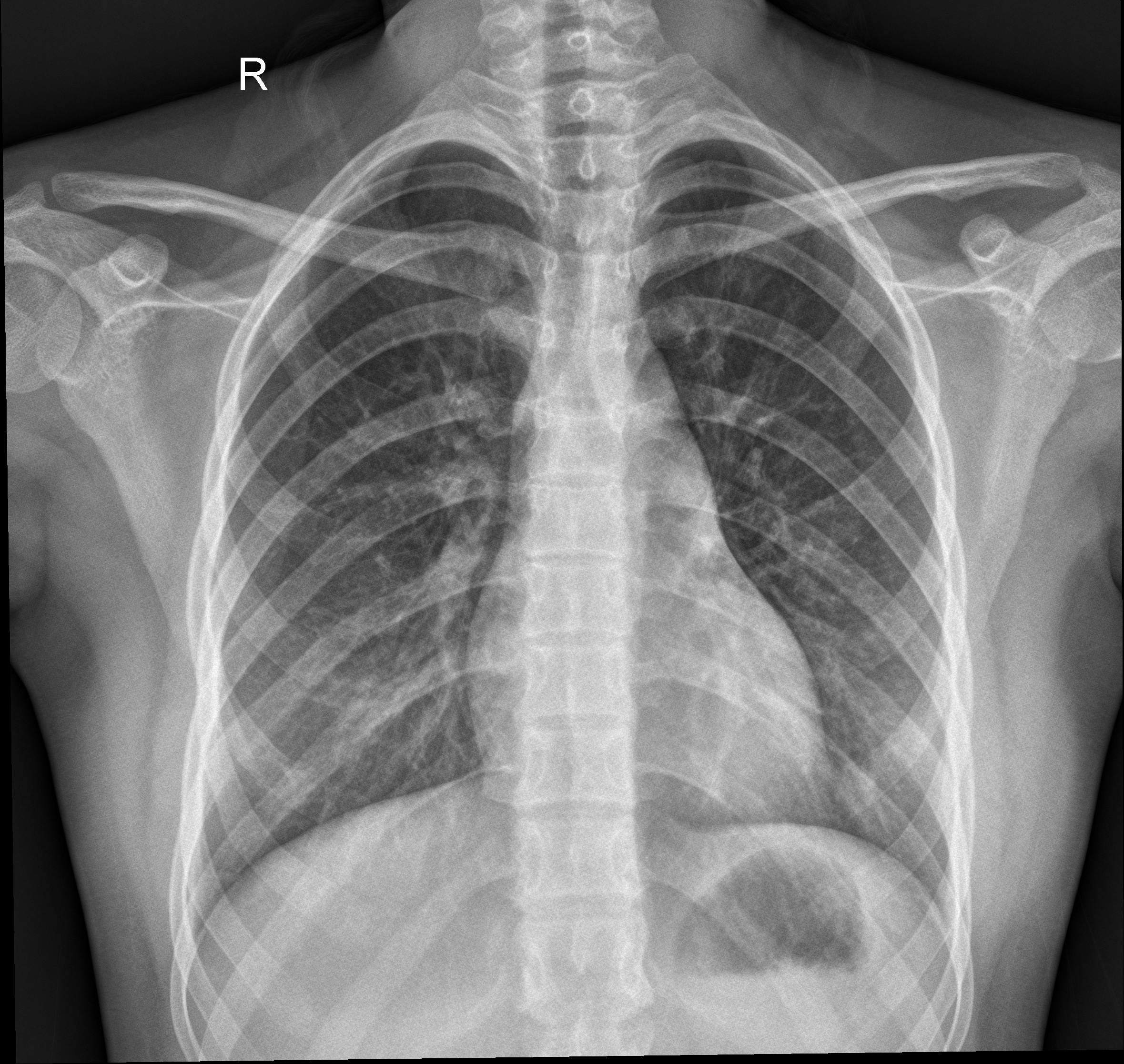 Pneumonia classification dataset by pnemonia