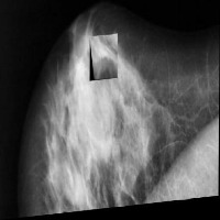breast cancer project thumbnail