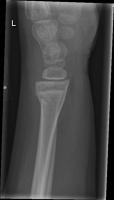GrazpedWRI_Fracture project thumbnail