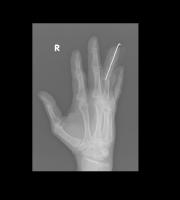 Wrist Xray project thumbnail