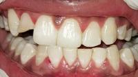 tooth_frontal project thumbnail