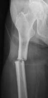 Types of Bone Fracture Detection project thumbnail