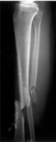leg_shinebone project thumbnail