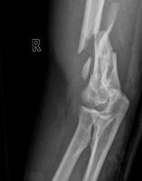 BoneFracture_Hand project thumbnail