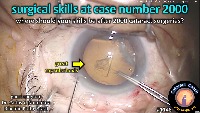 K_CC_1148_2000 cataract project thumbnail