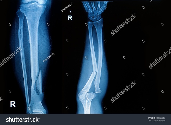 X ray bone fracture Object Detection Dataset and Pre-Trained Model by Unit