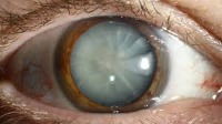 Cataract detect project thumbnail
