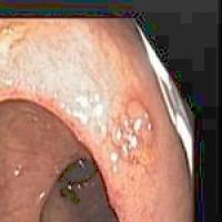 pepticulcer 117375 project thumbnail