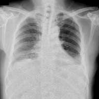 CXR_Cardio project thumbnail