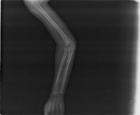 Bone Fractures project thumbnail