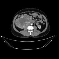 kidney project thumbnail