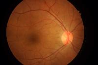 Macular Edema 2 project thumbnail