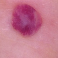 skin_lesion_classification project thumbnail