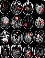 Brain Cancer Detection project thumbnail
