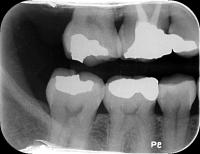 recurrent caries project thumbnail