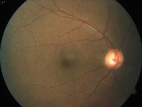 retinal project thumbnail