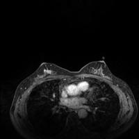 breast-cancer-mri project thumbnail