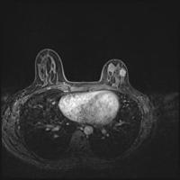breast cancer detection project thumbnail