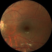 EyeSegmentation project thumbnail