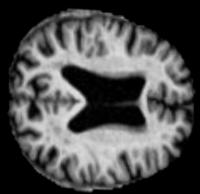 mri stroke object detection project thumbnail