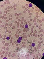 IA na Hematologia project thumbnail