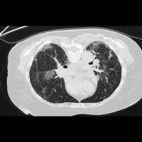 Lung-Segmentation project thumbnail