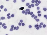 Malaria Detection B project thumbnail