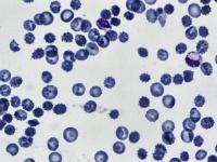 Malaria Detection project thumbnail