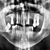 teeth_arxiv project thumbnail