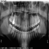 Tooth OD project thumbnail