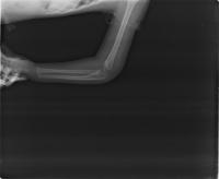 fractures project thumbnail