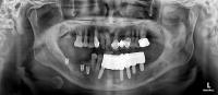 implant project thumbnail