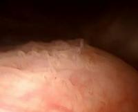 bladdercancer1234 project thumbnail