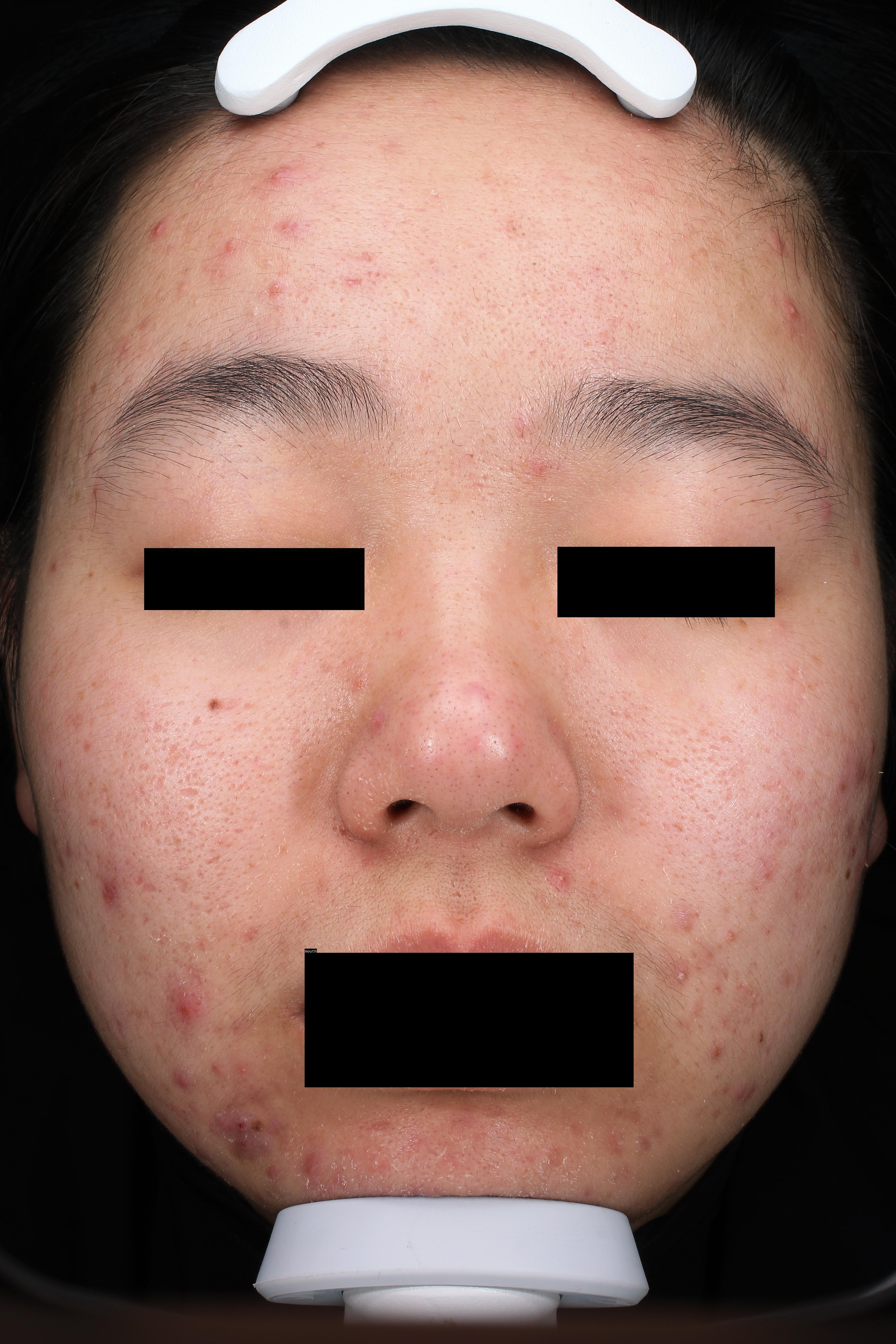 Acne Detection Object Detection Model by faceinc