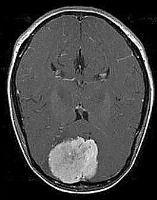 Brain Tumor project thumbnail